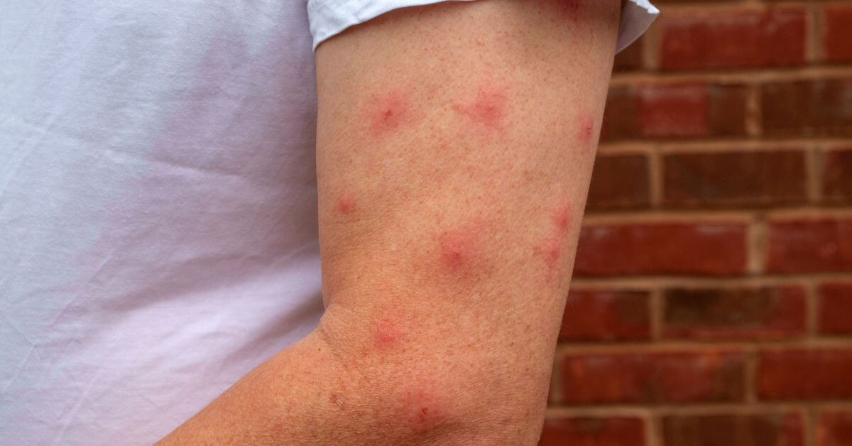 mosquito bites - Monetha